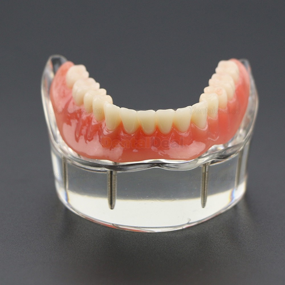 Dental Teeth Implant Overdenture Model Demo Study 6002 02 Lower Jaw 4 Implants